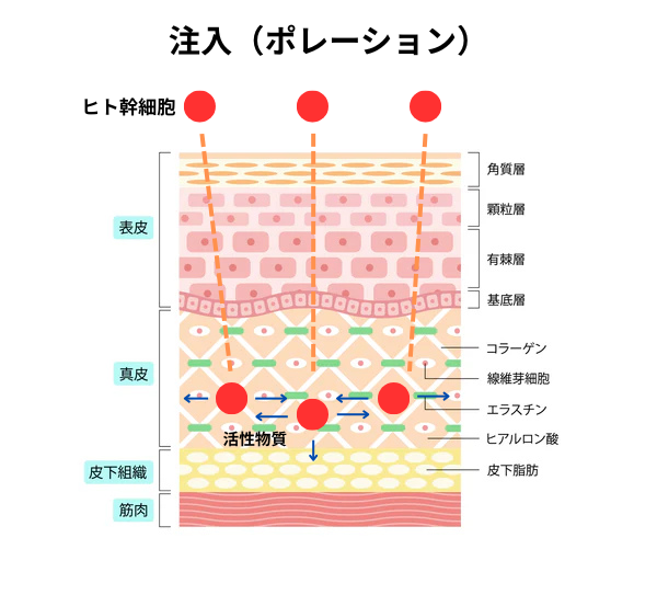 注入ポレーション