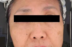 紫外線によるできたシミ