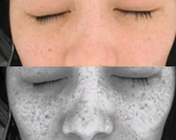 ソバカス（雀卵斑）