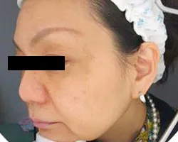 肝斑（頬骨の出ている部分など左右対称にできているシミ）