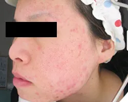 ニキビ跡・傷跡による色素沈着